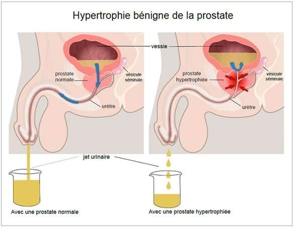 Adénome de la prostate traitement naturel