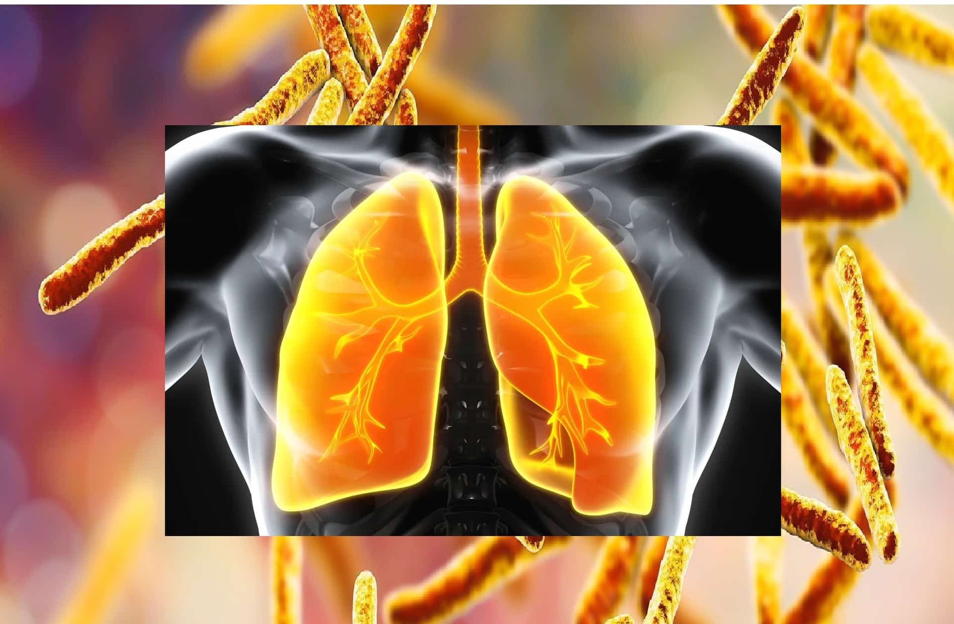 La tuberculose symptômes et traitement