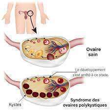 Hypertrophie Ovarienne: Causes et traitement naturel de l´hypertrophie ovarienne