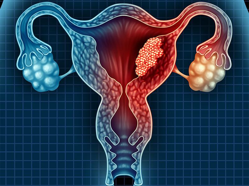 Cancer du col de l'utérus remède naturel